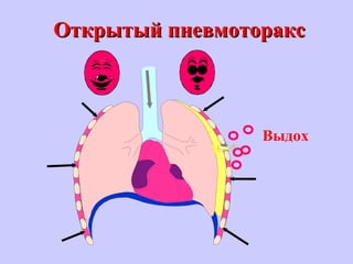 Открытый пневмотораксОткрытый пневмоторакс
Выдох
 