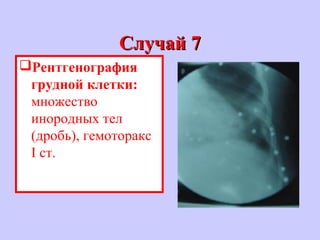 Случай 7Случай 7
Рентгенография
грудной клетки:
множество
инородных тел
(дробь), гемоторакс
I ст.
 