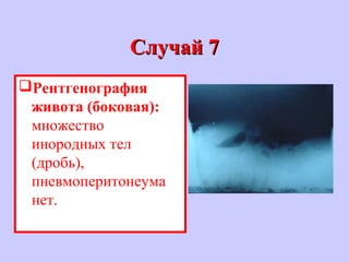 Случай 7Случай 7
Рентгенография
живота (боковая):
множество
инородных тел
(дробь),
пневмоперитонеума
нет.
 
