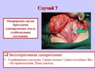 Случай 7Случай 7
Эксплоративная лапаротомия:
• 3 перфорации в желудке, 2 раны печени, 1 рана селезёнки. Все
– без кровотечения. Раны зашиты.
Оперирован двумя
бригадами
одновременно, после
стабилизации
состояния.
 