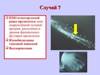 Случай 7Случай 7
 ПХО огнестрельной
раны предплечья, шов
повреждённой лучевой
артерии, рассечение и
дренаж фасциальных
футляров предплечья.
 Иммобилизация
гипсовой повязкой
 Выздоровление
 