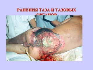 РАНЕНИЯ ТАЗА И ТАЗОВЫХРАНЕНИЯ ТАЗА И ТАЗОВЫХ
ОРГАНОВОРГАНОВ
 