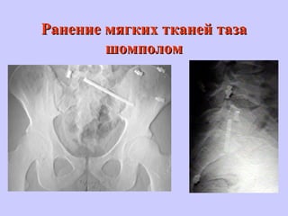 Ранение мягких тканей тазаРанение мягких тканей таза
шомполомшомполом
 