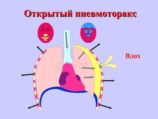 Открытый пневмотораксОткрытый пневмоторакс
Вдох
 