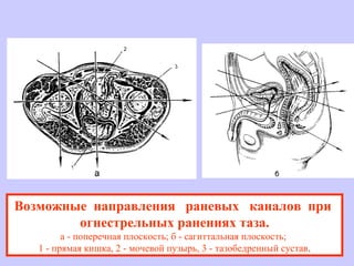 Возможные направления раневых каналов при
огнестрельных ранениях таза.
а - поперечная плоскость; б - сагиттальная плоскость;
1 - прямая кишка, 2 - мочевой пузырь, 3 - тазобедренный сустав.
 