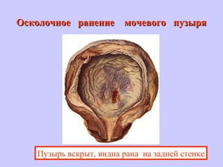 Осколочное ранение мочевого пузыряОсколочное ранение мочевого пузыря
Пузырь вскрыт, видна рана на задней стенке
 