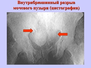 Внутрибрюшинный разрывВнутрибрюшинный разрыв
мочевого пузыря (цистография)мочевого пузыря (цистография)
 