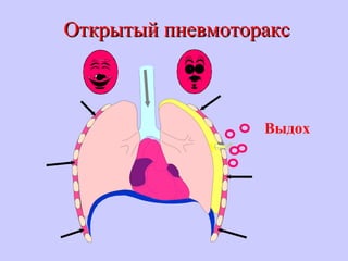 Открытый пневмотораксОткрытый пневмоторакс
Выдох
 
