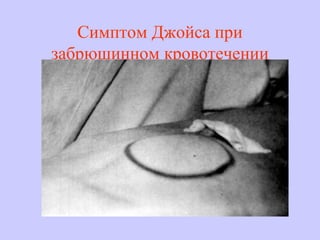 Симптом Джойса при
забрюшинном кровотечении
 