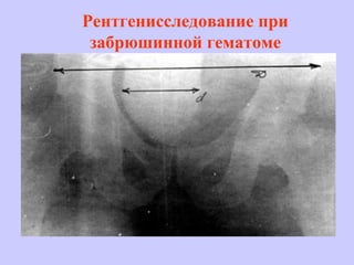 Рентгенисследование при
забрюшинной гематоме
 