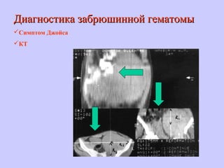 Диагностика забрюшинной гематомыДиагностика забрюшинной гематомы
Симптом Джойса
КТ
 