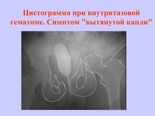 Цистограмма при внутритазовой
гематоме. Симптом "вытянутой капли"
 