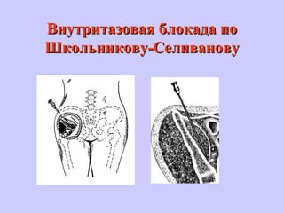 Внутритазовая блокада поВнутритазовая блокада по
Школьникову-СеливановуШкольникову-Селиванову
 