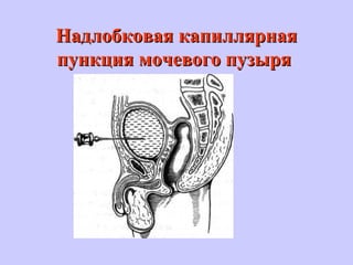 Надлобковая капиллярнаяНадлобковая капиллярная
пункция мочевого пузыряпункция мочевого пузыря
 
