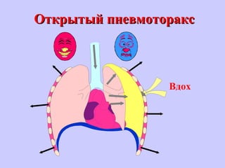 Открытый пневмотораксОткрытый пневмоторакс
Вдох
 