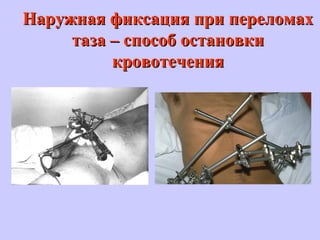 Наружная фиксация при переломахНаружная фиксация при переломах
таза – способ остановкитаза – способ остановки
кровотечениякровотечения
 