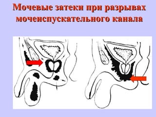 Мочевые затеки при разрывахМочевые затеки при разрывах
мочеиспускательного каналамочеиспускательного канала
 
