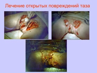 Лечение открытых повреждений таза
 