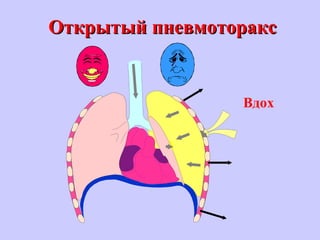 Открытый пневмотораксОткрытый пневмоторакс
Вдох
 