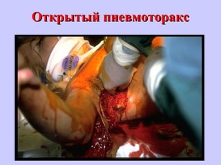 Открытый пневмотораксОткрытый пневмоторакс
 