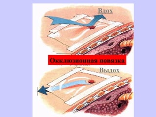 Вдох
Выдох
Окклюзионная повязка
 