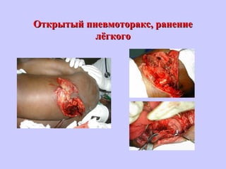 Открытый пневмоторакс, ранениеОткрытый пневмоторакс, ранение
лёгкоголёгкого
 