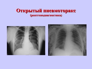 Открытый пневмотораксОткрытый пневмоторакс
(рентгенодиагностика)(рентгенодиагностика)
 