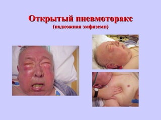 Открытый пневмотораксОткрытый пневмоторакс
(подкожная эмфиземп)(подкожная эмфиземп)
 