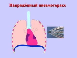 Напряжённый пневмотораксНапряжённый пневмоторакс
 