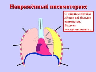 Напряжённый пневмотораксНапряжённый пневмоторакс
С каждым вдохом
лёгкое всё больше
сжимается.
Воздуху
некуда выходить ...
 