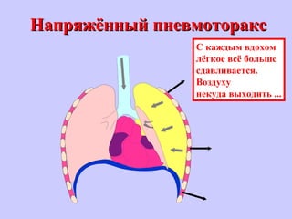 Напряжённый пневмотораксНапряжённый пневмоторакс
С каждым вдохом
лёгкое всё больше
сдавливается.
Воздуху
некуда выходить ...
 