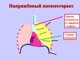 Сердце
сдавлено
Трахея
смещается
в здоровую
сторону
Напряжённый пневмотораксНапряжённый пневмоторакс
 