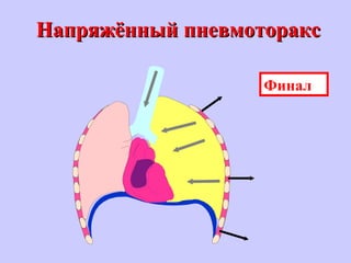 Напряжённый пневмотораксНапряжённый пневмоторакс
Финал
 