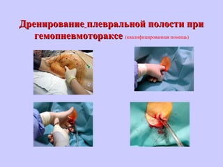 ДренированиеДренирование плевральной полости приплевральной полости при
гемопневмотораксегемопневмотораксе (квалифицированная помощь)
 