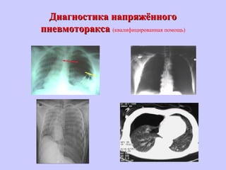 Диагностика напряжённогоДиагностика напряжённого
пневмотораксапневмоторакса (квалифицированная помощь)
 