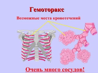 ГемотораксГемоторакс
Очень много сосудов!
Возможные места кровотечений
 