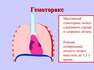 ГемотораксГемоторакс
Массивный
гемоторакс может
сдавливать сердце
и здоровое лёгкое.
Каждая
плевральная
полость может
вместить до 1,5 л
крови...
 