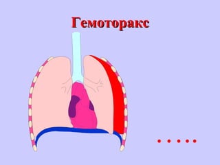 ГемотораксГемоторакс
…..
 