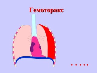 ГемотораксГемоторакс
…..
 