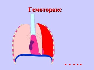 ГемотораксГемоторакс
…..
 