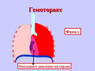 ГемотораксГемоторакс
Оказывает давление на сердце
Финал
 