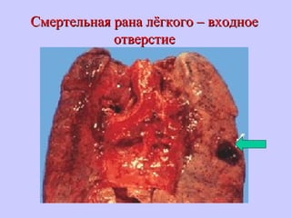 Смертельная рана лёгкого – входноеСмертельная рана лёгкого – входное
отверстиеотверстие
 