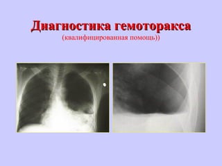 Диагностика гемотораксаДиагностика гемоторакса
(квалифицированная помощь))
 