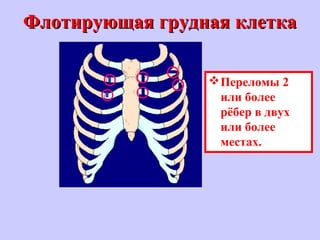 Флотирующая грудная клеткаФлотирующая грудная клетка
Переломы 2
или более
рёбер в двух
или более
местах.
 
