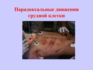 Парадоксальные движения
грудной клетки
 
