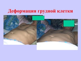 Деформация грудной клетки
 