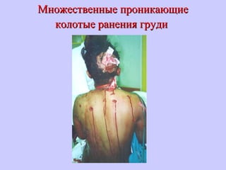 Множественные проникающиеМножественные проникающие
колотые ранения грудиколотые ранения груди
 