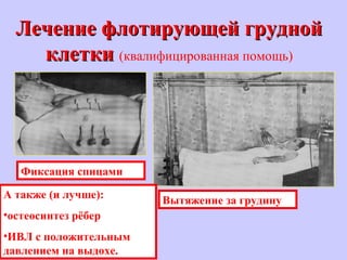 Лечение флотирующей груднойЛечение флотирующей грудной
клеткиклетки (квалифицированная помощь)
Фиксация спицами
Вытяжение за грудину
А также (и лучше):
•остеосинтез рёбер
•ИВЛ с положительным
давлением на выдохе.
 