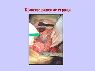 Колотое ранение сердцаКолотое ранение сердца
 