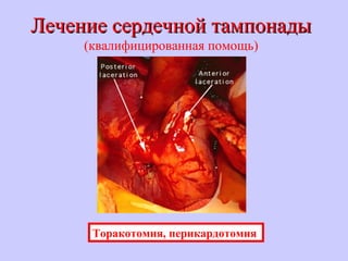 Лечение сердечной тампонадыЛечение сердечной тампонады
(квалифицированная помощь)
Торакотомия, перикардотомия
 